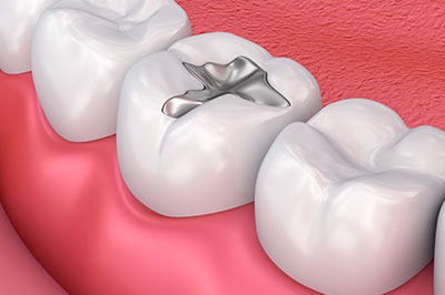 amalgam fills